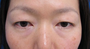 目の下のたるみ、目のくまでお悩みの方、切らずに完璧に解決します。TCB-R法　手術直後　症例写真
